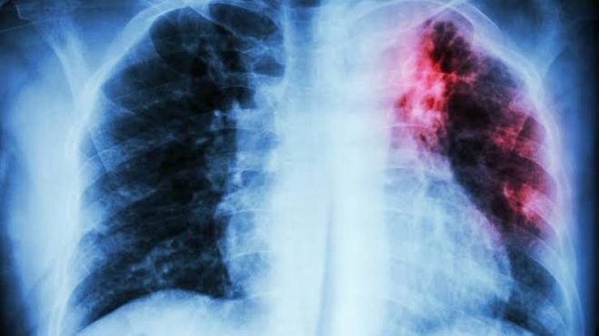 Fibrosis Pulmonar Idiopática, una rara enfermedad que puede robarte el aliento