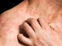 Eczcema o Eccema: Causas, Tipos y Tratamientos. 